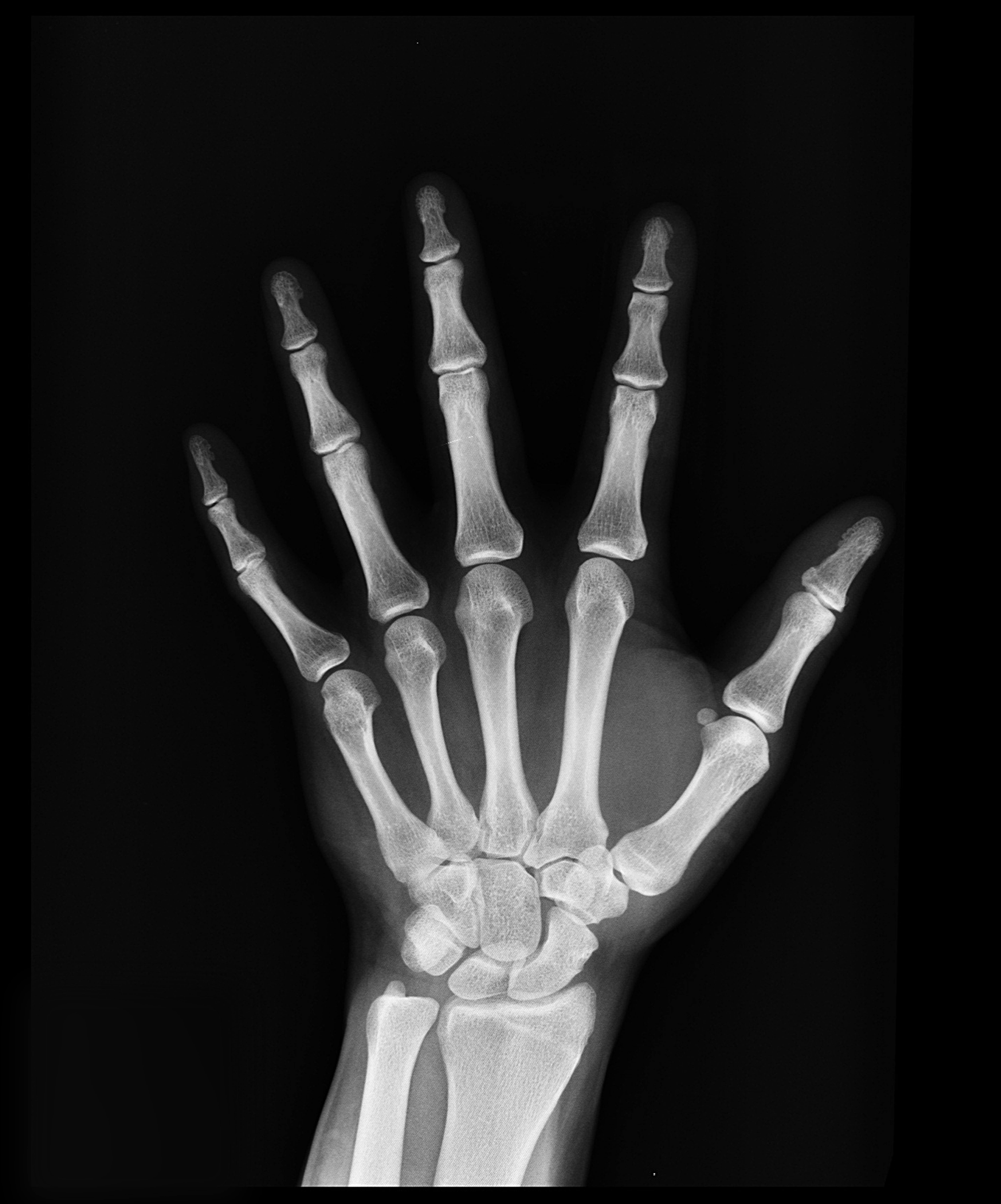 Joint replacement
